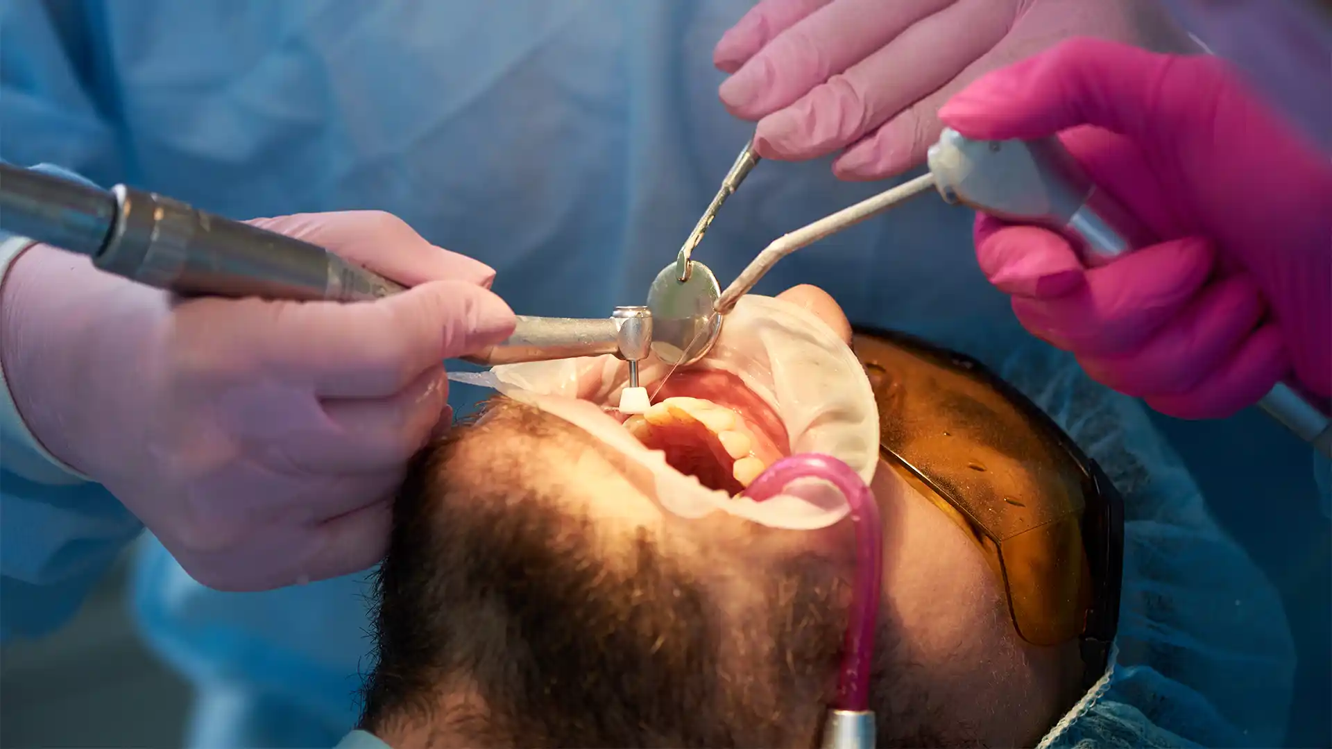 Hollywood Smile Makeover in Turchia per i Russi